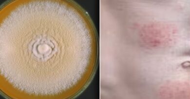 Doctors issue warning over hard-to-treat ‘super-fungus’ likely to be spreading undetected in Britain​