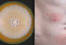 Doctors issue warning over hard-to-treat ‘super-fungus’ likely to be spreading undetected in Britain​