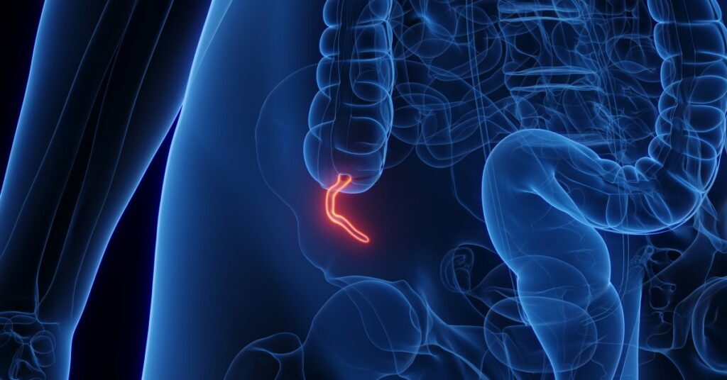 Appendix Cancer Has Quadrupled in Millennials