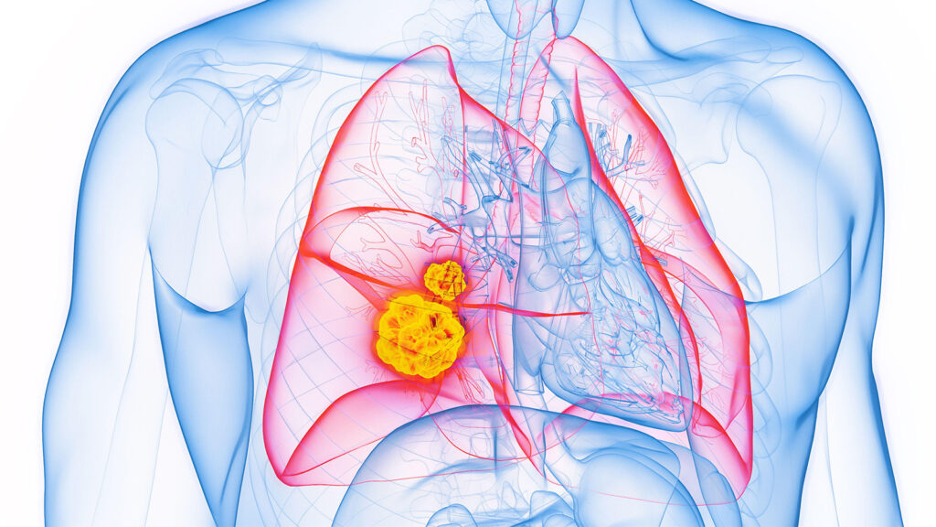 Weighing Options for First-Line Therapy in EGFR-Mutated NSCLC Weighing Options for First-Line Therapy in EGFR-Mutated NSCLC