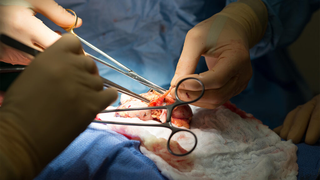 Kidney Transplantation Without Lifelong Immunosuppression Edges Toward Reality