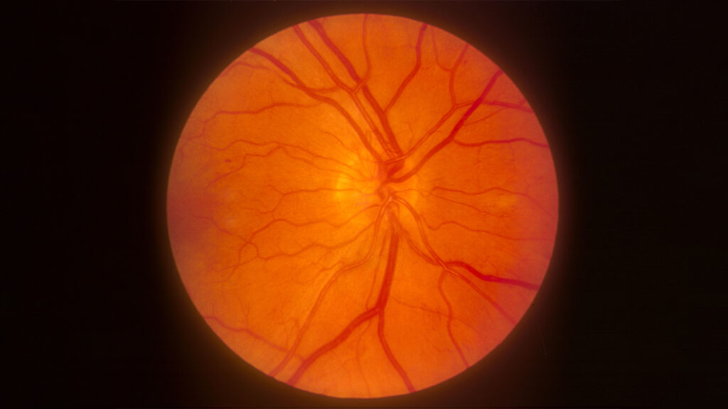 Popular Diabetes Drugs Linked to Small Risk of Retinal, Optic Nerve Disorders