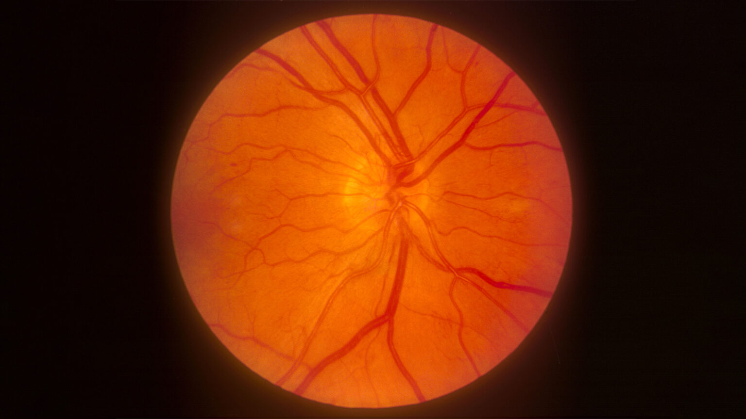 Popular Diabetes Drugs Linked to Small Risk of Retinal, Optic Nerve Disorders