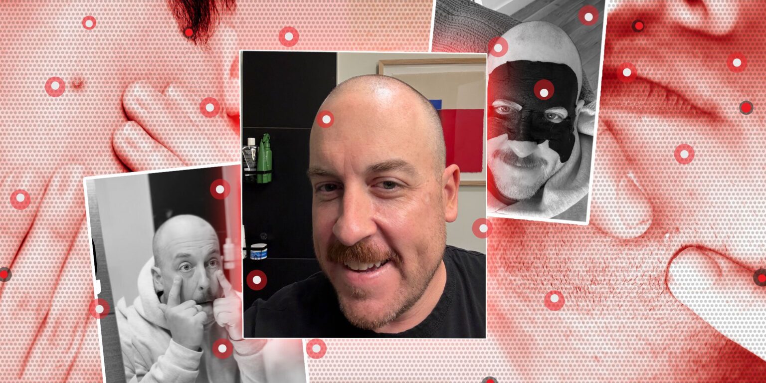 Yeah, I Still Get Pimples at 43 Years Old. Here’s How I Clear ‘Em Up.