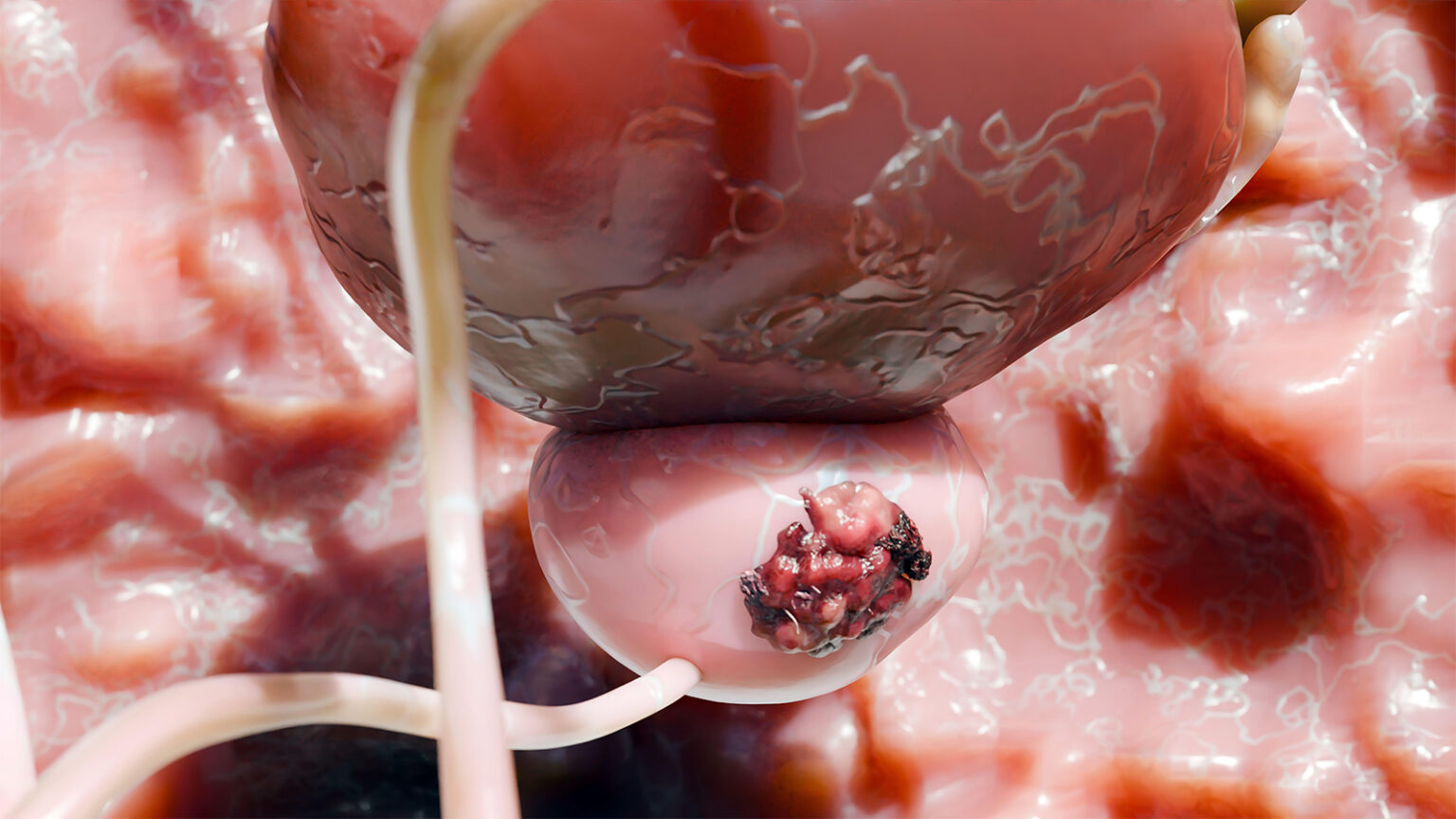 More Advanced Prostate Cancers After USPSTF Guideline Change