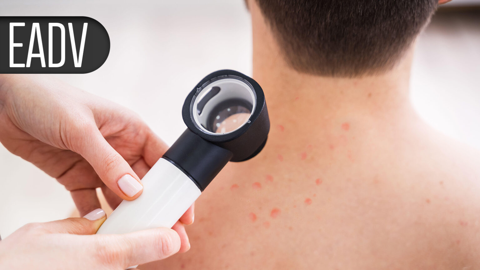 ‘Hit Hard, Hit Early’ Psoriasis Treatment Strategy Gains Momentum