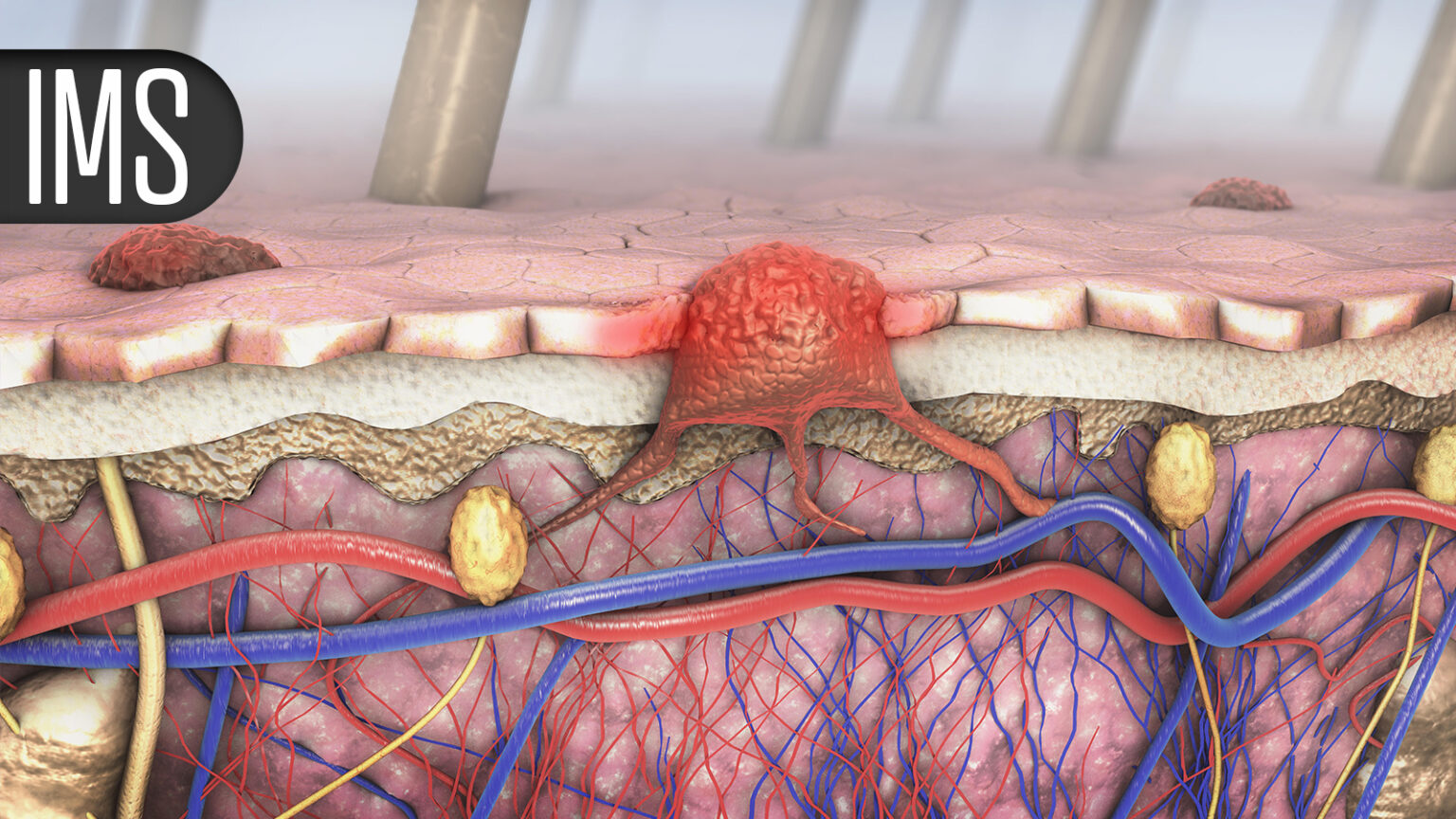Linvoseltamab Promising in High-Risk Smoldering Multiple Myeloma