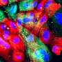 Targeting enzymes to weaken cancer cells could supercharge prostate cancer treatment Targeting enzymes to weaken cancer cells could supercharge prostate cancer treatment