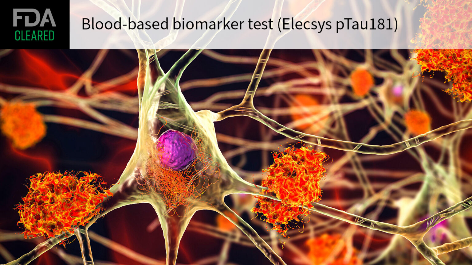 Alzheimer’s Blood Test Cleared for Primary Care Use Alzheimer’s Blood Test Cleared for Primary Care Use