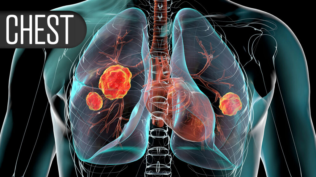 Adverse Event Risks Vary Among Asthma Biologics, FDA Data Show