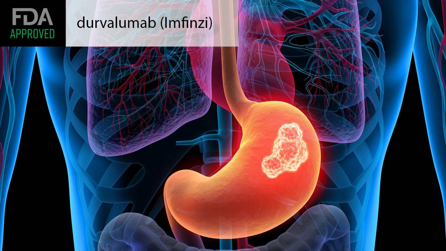FDA OKs Perioperative Immunotherapy for Stomach Cancer