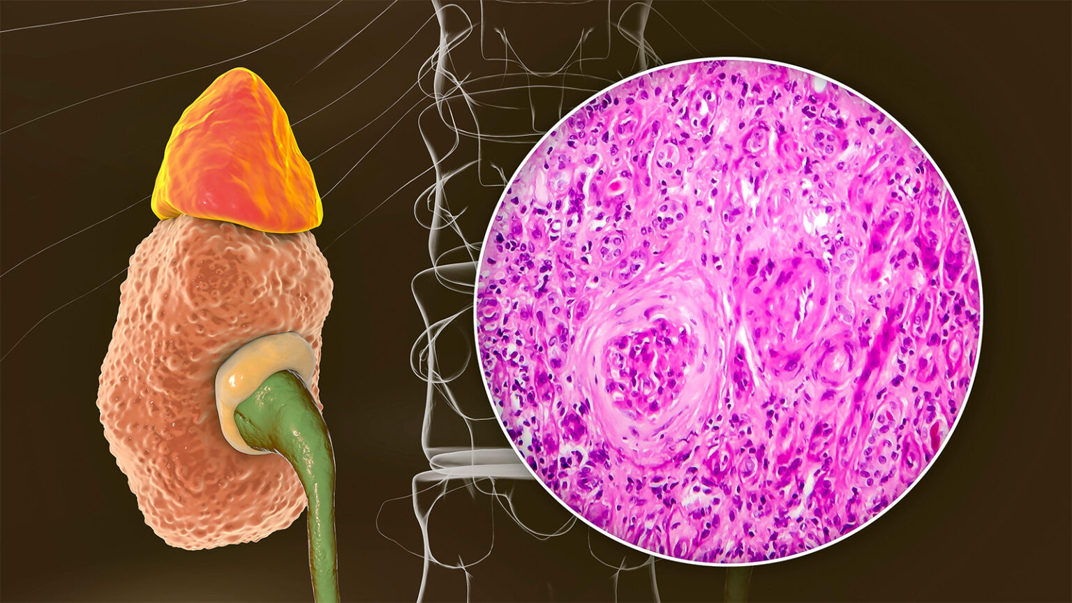 Here’s the Data Supporting Pegcetacoplan’s Approval in Two Rare Kidney Diseases