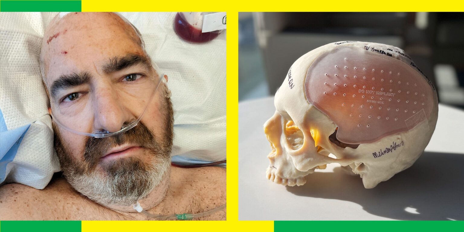 I Survived Losing Nearly Half My Skull. My Lifesaver: A 3D-Printed Skull.