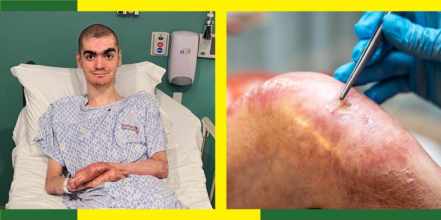 I Survived a Dangerous and Painful Skin Disorder