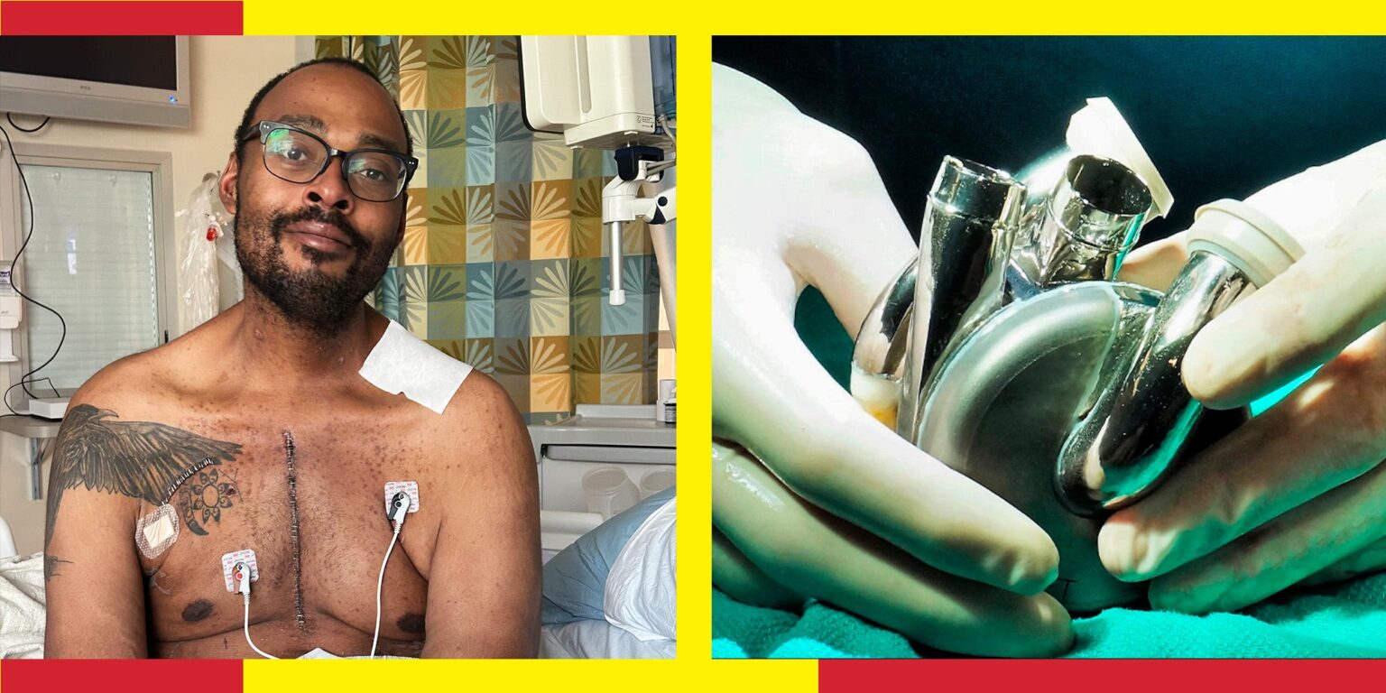 I Survived a Rapidly Failing Heart. My Lifesaver: A Titanium Ticker. I Survived a Rapidly Failing Heart. My Lifesaver: A Titanium Ticker.