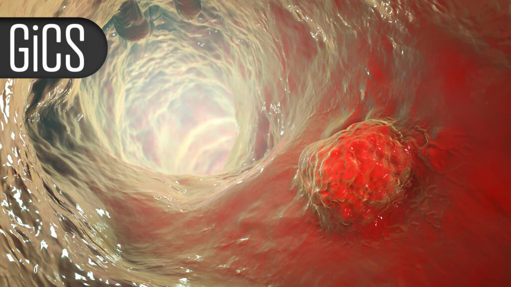 CAR-Like T Cells Enhance Tumor Response in Gastroesophageal Cancer