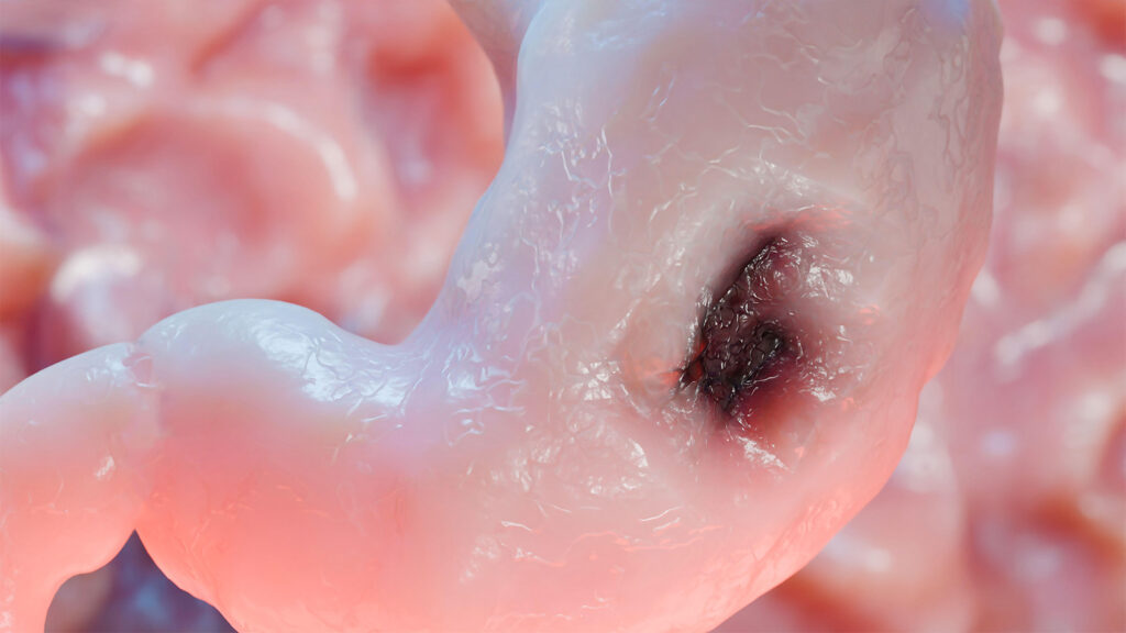 Long-Term Anti-Acid Drugs and Stomach Cancer: Is There a Link?