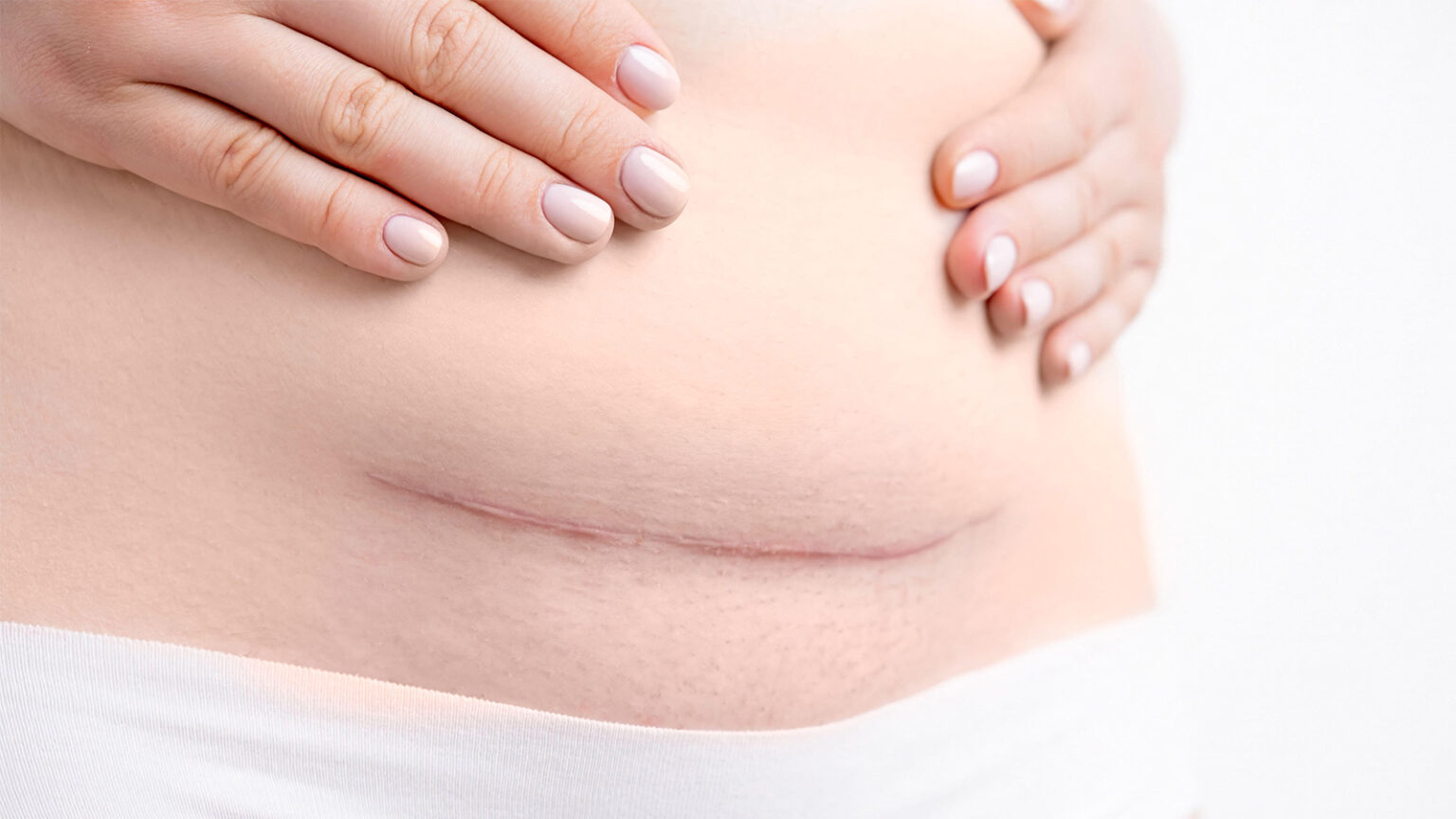 Can This Cesarean Closure Technique Reduce Complications?