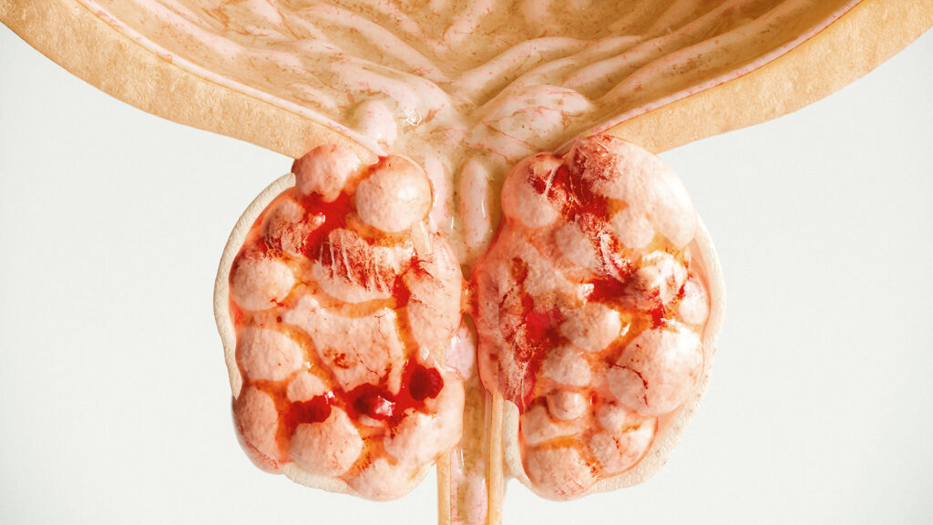 Similar Prostate Cancer Drugs Show Different Results in Real-World Study