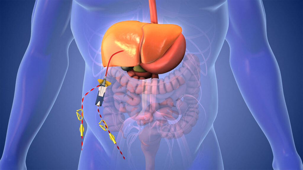 Dual Immunotherapy and Liver Perfusion Delays Progression in Uveal Melanoma