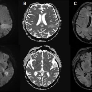 You’re likely already infected with a brain-eating virus you’ve never heard of You’re likely already infected with a brain-eating virus you’ve never heard of