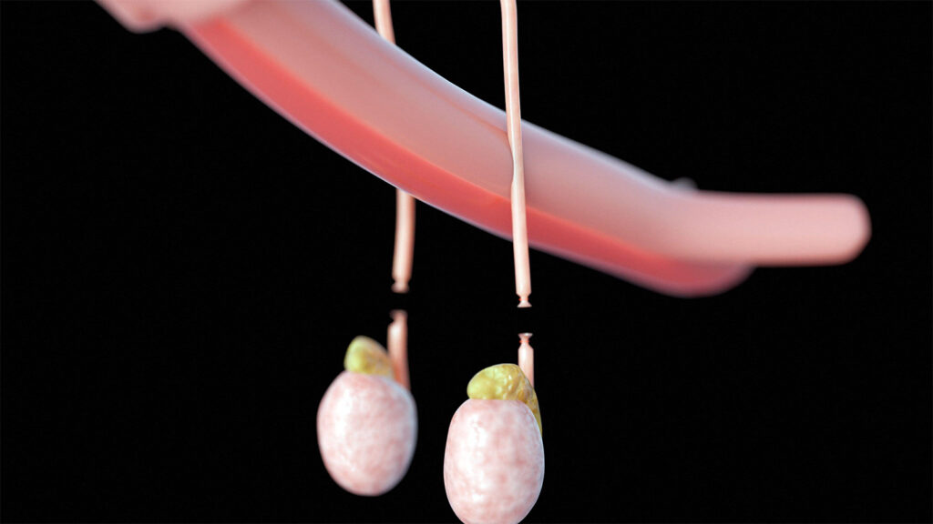 The Vasectomy Conversation: Guideline Reflects Changes in Patients, Talking Points