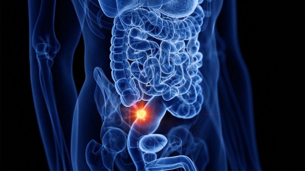 Are We Missing Tumors When Using Antibiotics Alone for Appendicitis?