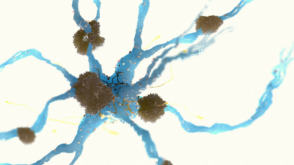 New Study Links Alzheimer’s Findings to Old Medical Treatments