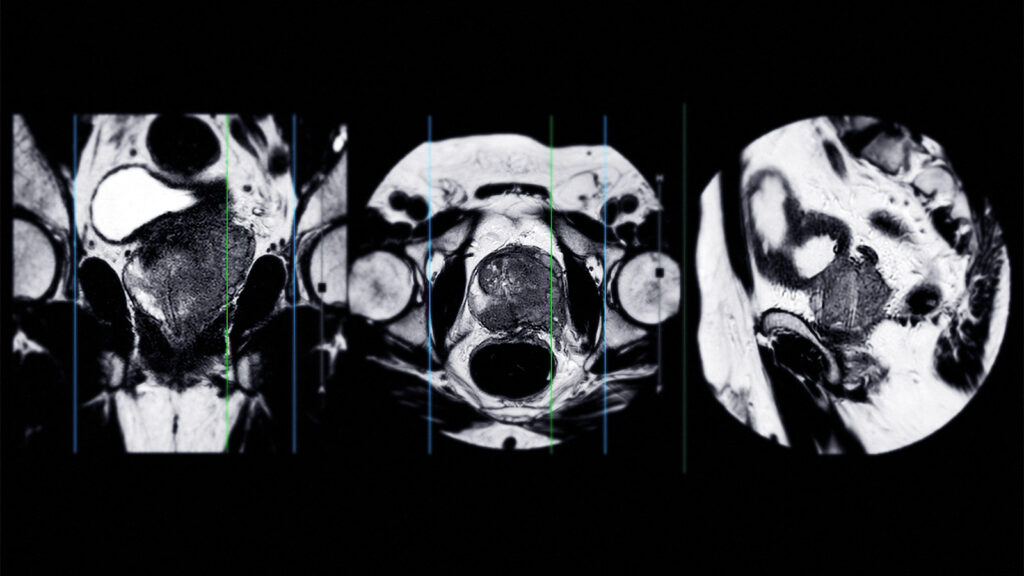 MRI Before Treatment Could Provide Prognostic Information in Prostate Cancer
