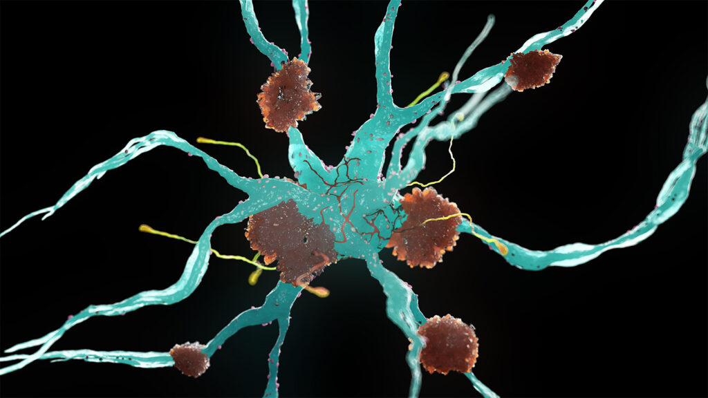 Alzheimer’s Risk May Be Influenced by Flu Shots