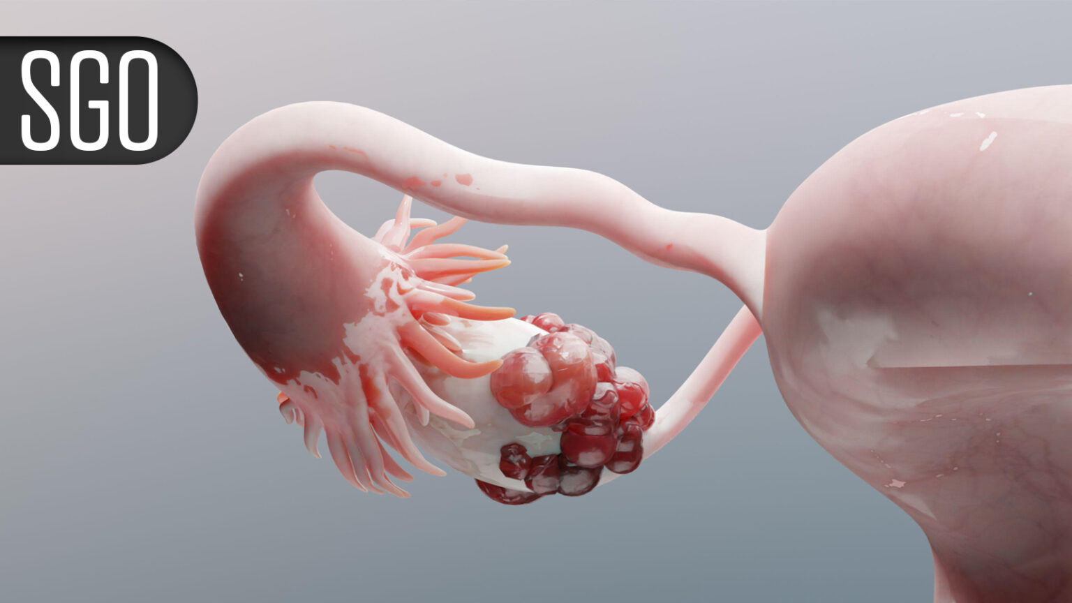 Novel Regimen Boosts Survival for Recurrent Platinum-Resistant Ovarian Cancer