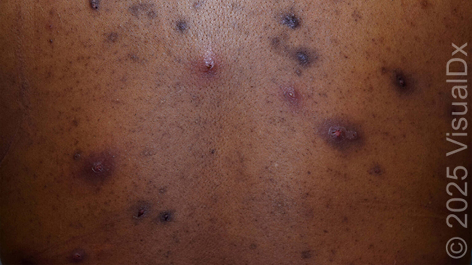 Make the Diagnosis: Is This Eruption Related to the Patient’s Acne? His Ulcerative Colitis?