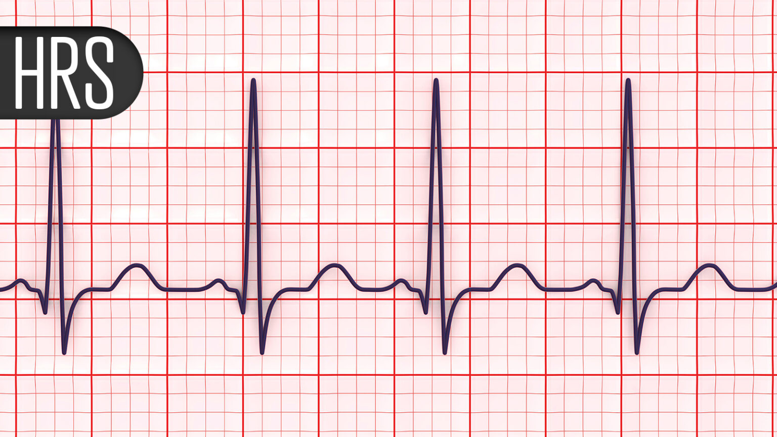 Think Heart Attacks Cause Most Sudden Cardiac Deaths? Think Again, Study Says
