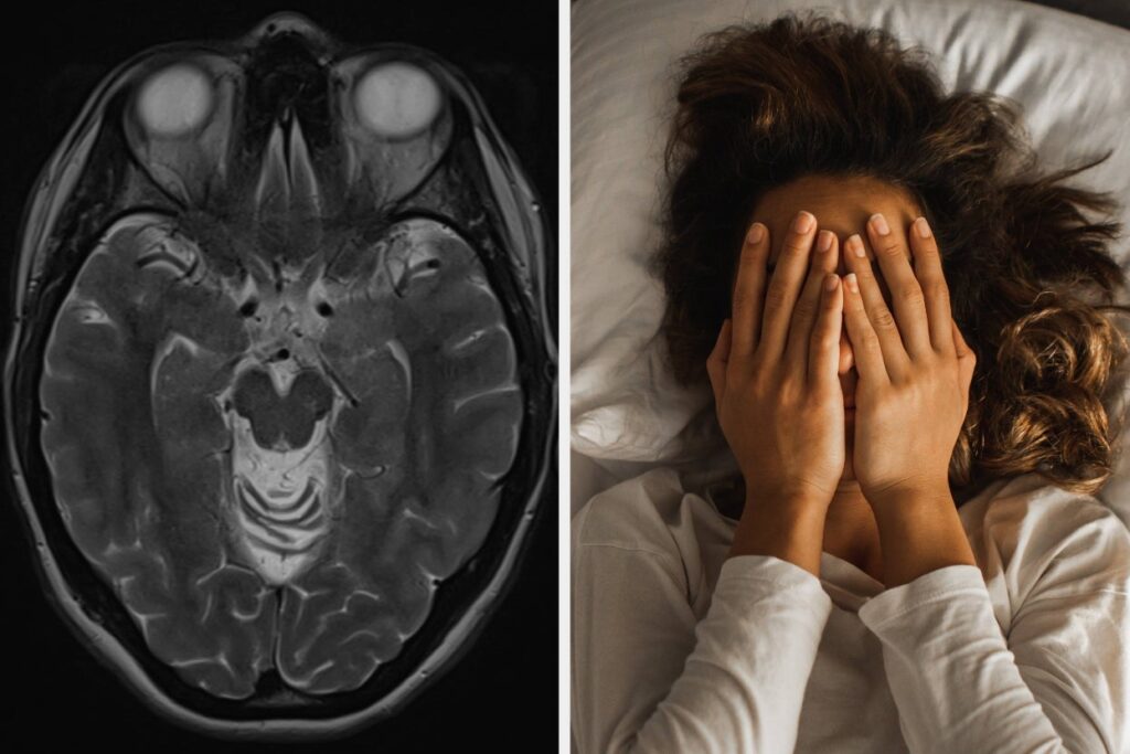 “Early Biomarkers Of Neurodegenerative Disease”: These 4 Sleep Problems Could Serve As Early Signs Of Dementia