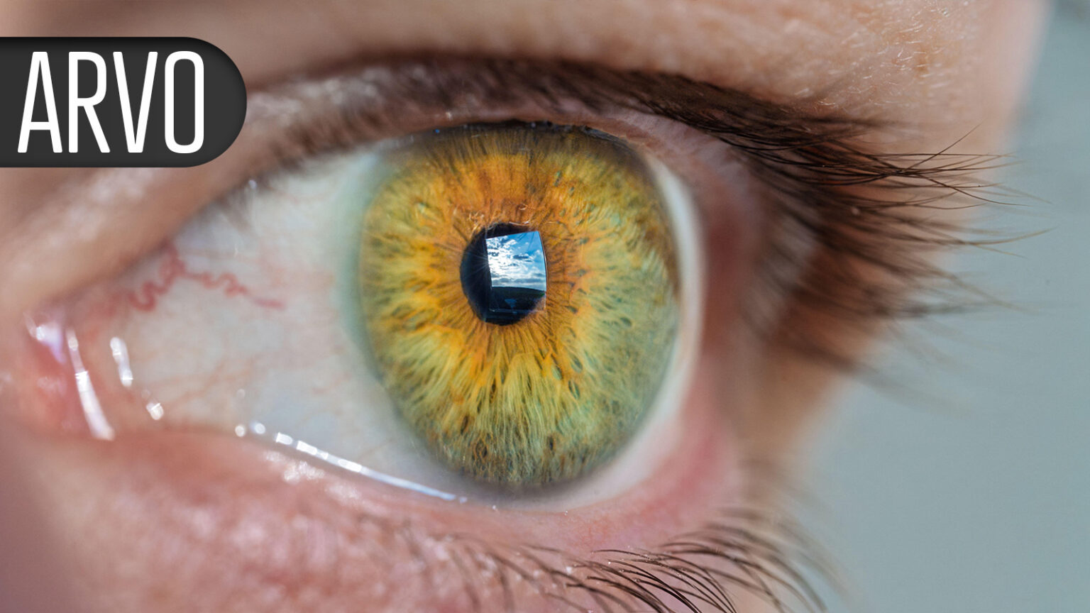 Vision-Correction Procedure Linked to Higher Level of Neuroticism Traits