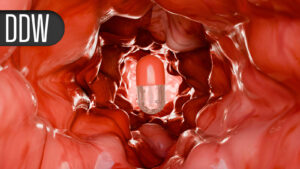 5-Year Data Support Top-Down Therapy in Crohn’s Disease