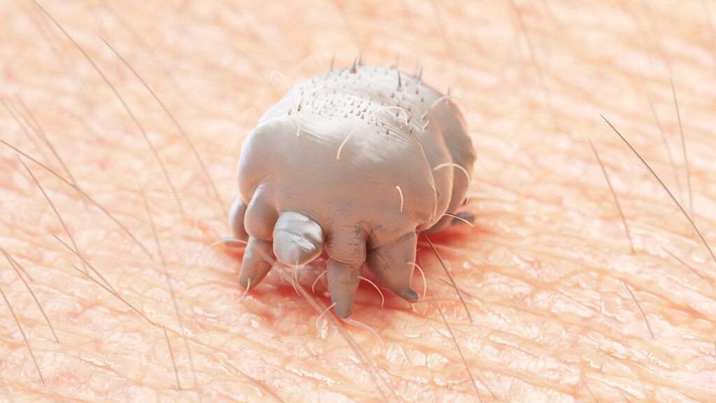 In Severe Scabies, Standard-Dose Ivermectin Superior to High Dose