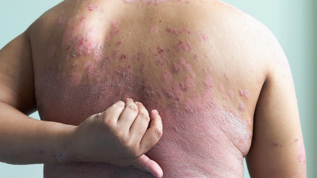 GLP-1 Drug Makes Its Case for Treating Plaque Psoriasis