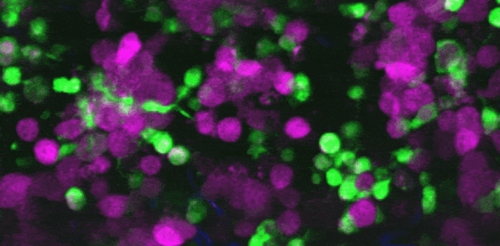 First video of immune cells eating live skin cancer in real time First video of immune cells eating live skin cancer in real time