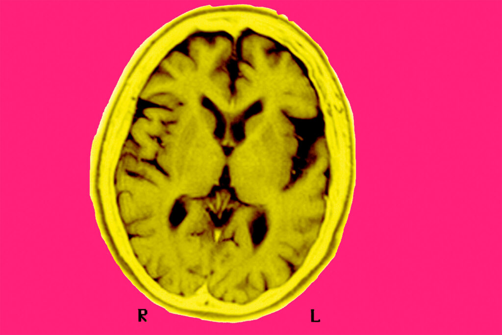 First-of-its-kind UCSF study shows blood test may catch early cognitive trouble