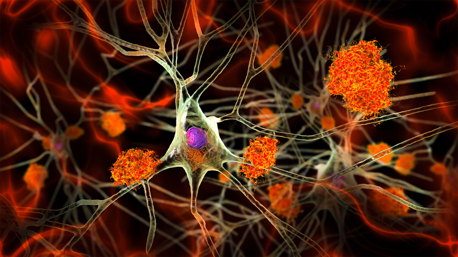 Alzheimer’s Signs Hidden in Midlife Brains, Study Shows