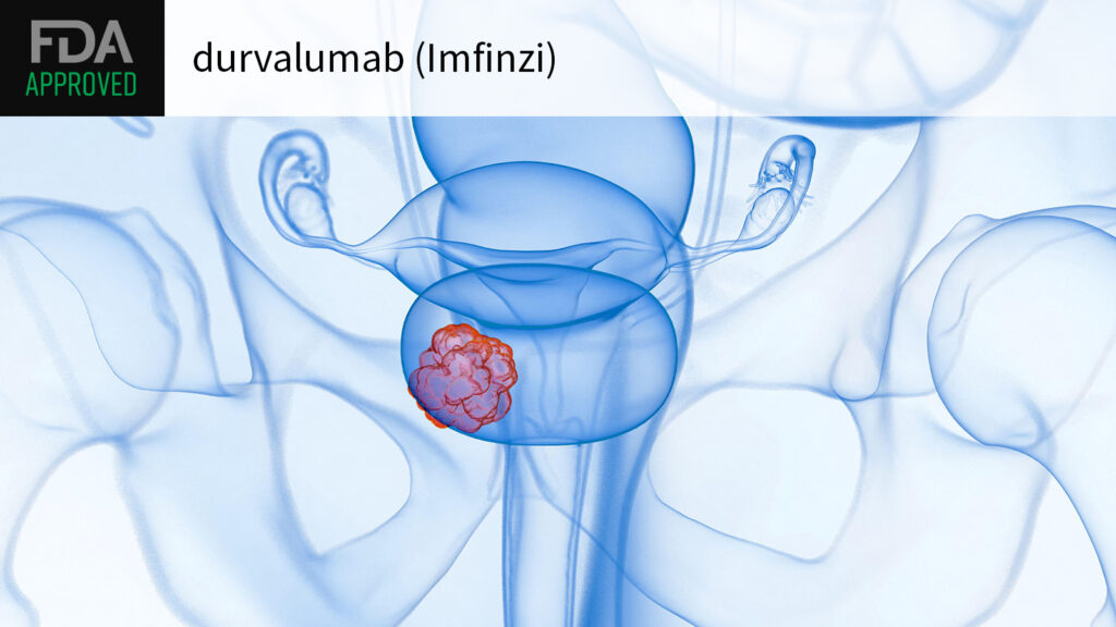 FDA OKs Immunotherapy-BCG Combo for High-Risk Bladder Cancer