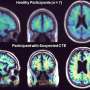PET suggests potential chronic traumatic encephalopathy biomarker in living humans
