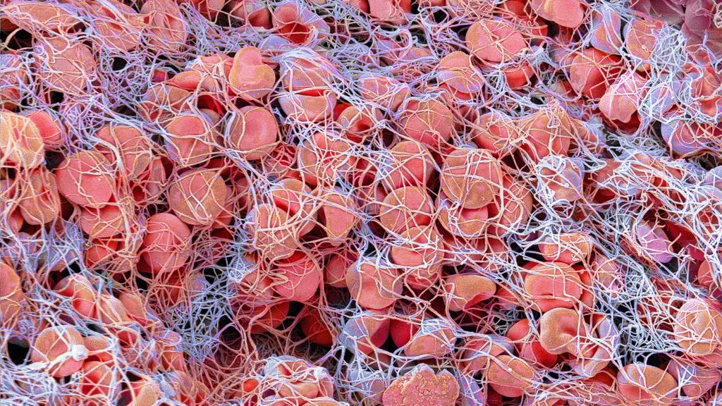 Tenecteplase Unseats Low-Dose Alteplase Favored for Asian Patients