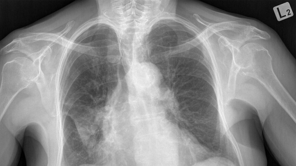 Shorter TB Regimen Matched Standard Care in Rifampicin-Resistant Disease