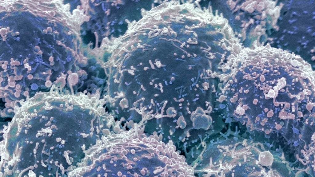Guidelines Help Spot Dermatomyositis Patients at High Risk for Cancer