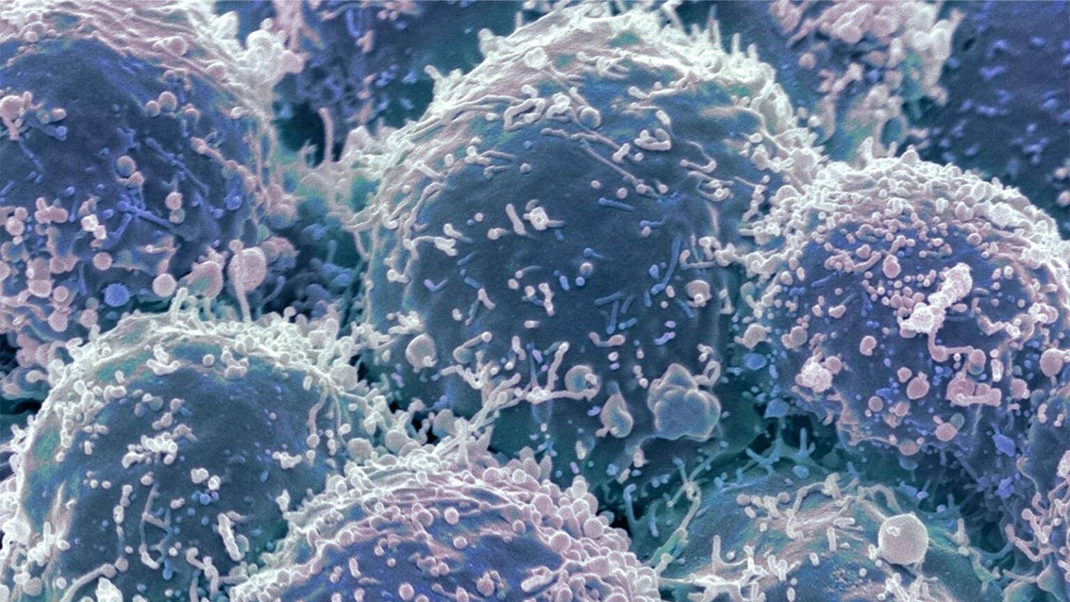Guidelines Help Spot Dermatomyositis Patients at High Risk for Cancer