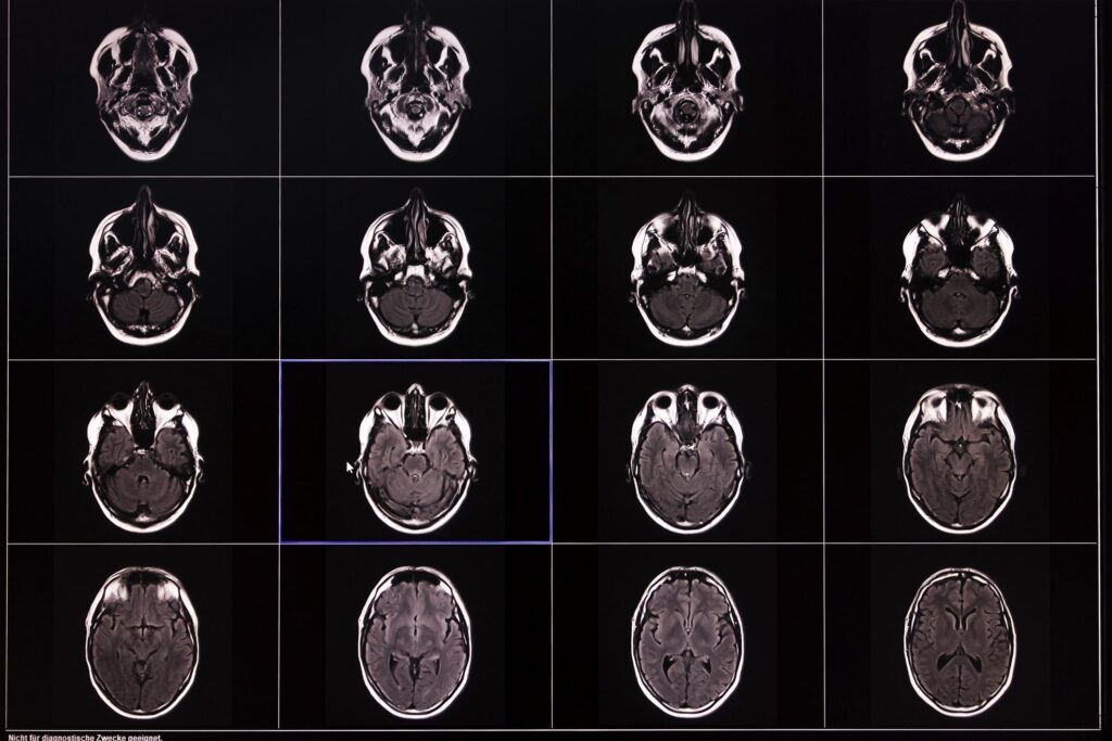 Scientists Studied Over 10,000 Brain Scans. What They Found Changes Everything We Knew About Memory Loss.