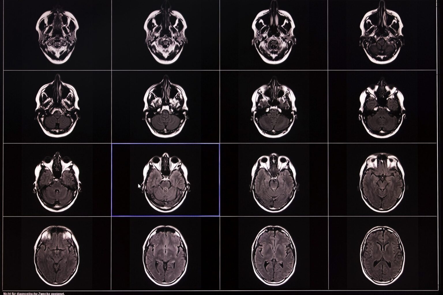 Scientists Studied Over 10,000 Brain Scans. What They Found Changes Everything We Knew About Memory Loss. Scientists Studied Over 10,000 Brain Scans. What They Found Changes Everything We Knew About Memory Loss.