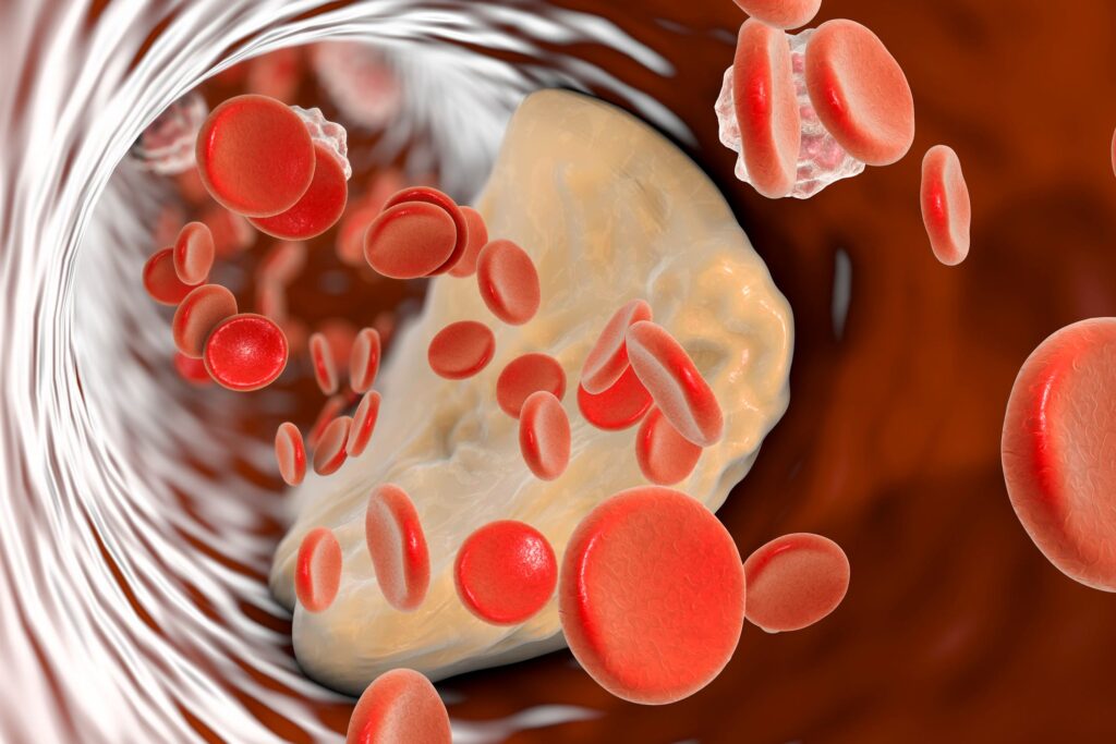 Cardiologists Say Adding This Quick Test Gives a  Clearer Picture on Cholesterol Levels